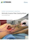 minimally invasive plate osteosynthesis mipo 2nd ed