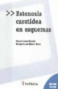 estenosis carotidea en esquemas