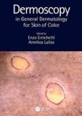 Dermoscopy In General Dermatology For Skin Of Color